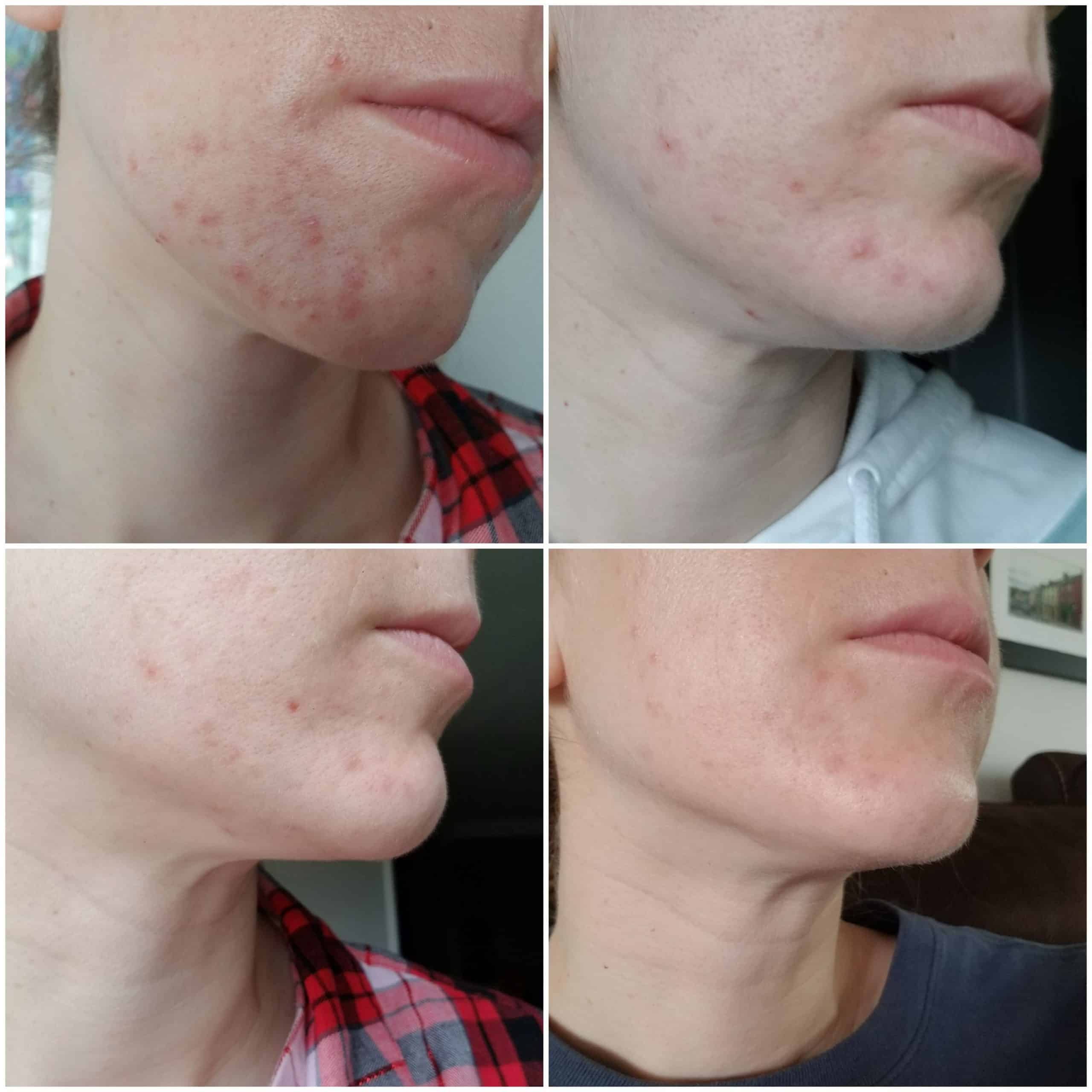 acne clearing from whole food plant based diet